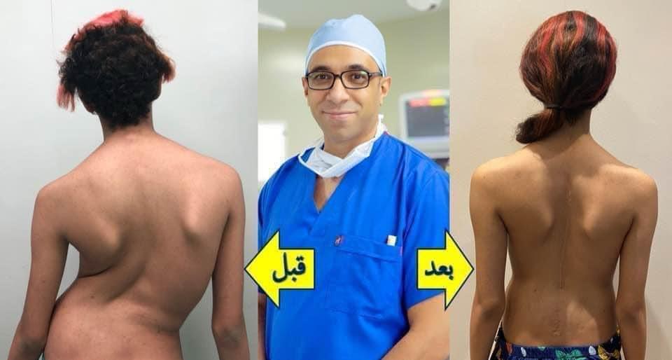 جراحات تصليح اعوجاج العمود الفقري (الجنف)